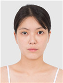 韩国TL整形外科隆鼻手术对比案例_术前