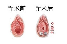 處女膜修復(fù)后出血怎么回事？