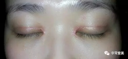 双眼皮修复可能会导致疤痕增生