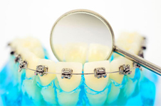 牙齿矫正经常出现的三大基础问题解答