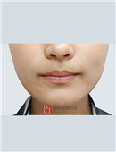 韩国如妃整形外科瘦脸针对比案例