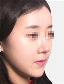 韩国RUBY-韩国如妃整形外科自体脂肪填充对比日记