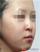 韩国RUBY医院隆鼻手术对比案例