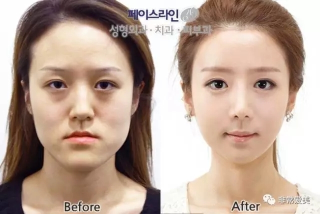 韩国菲斯莱茵和巴诺巴奇哪家医院做脸型更好？