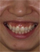 韩国江南美丽微笑牙科-牙齿矫正对比日记