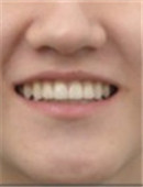 韩国江南美丽微笑牙科-牙齿矫正对比日记