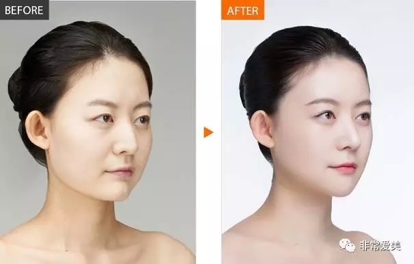 手术后的求美者脸型前后对比