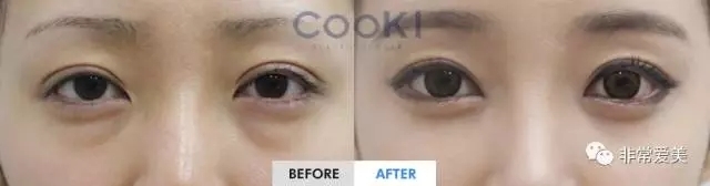 COOKI整形外科双眼皮修复对比