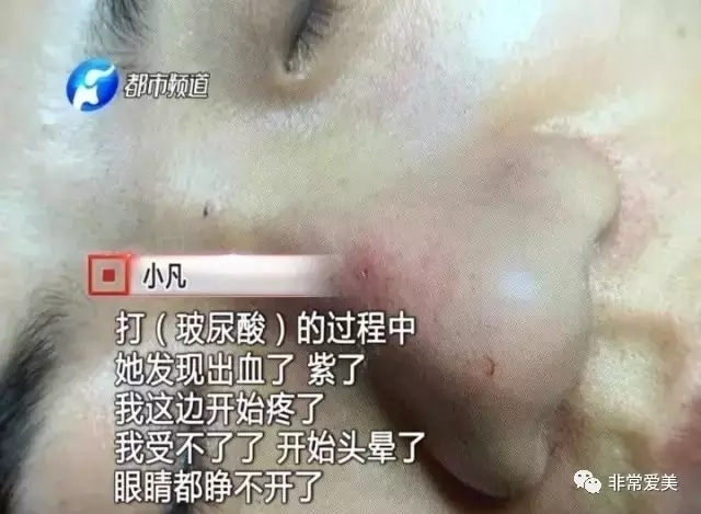 微整形黑幕 玻尿酸 掺水 后悔死了 非常爱美