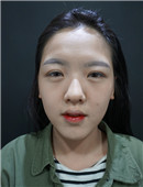 韩国首尔丽格皮肤科-玻尿酸注射丰下巴前后对比日记