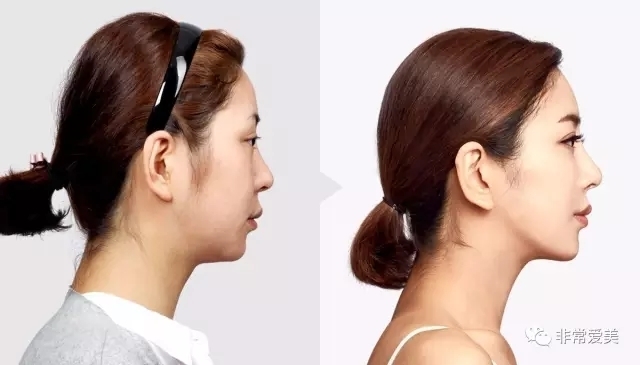 韩国TL整形外科假体隆鼻前后对比