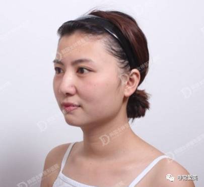 手术前求美者面部侧面具体形态