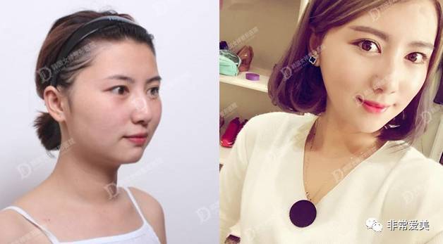 韩国女神整形外科，面部轮廓手术对比