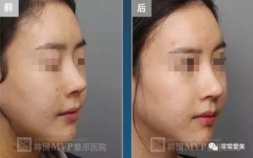 韩国MVP整形外科鼻尖修复对比