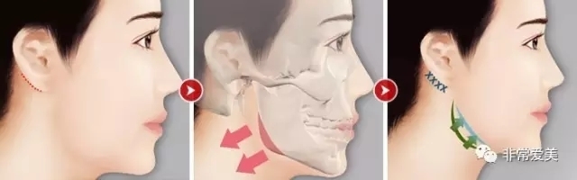 韩国医院做面部轮廓整形优势有哪些？