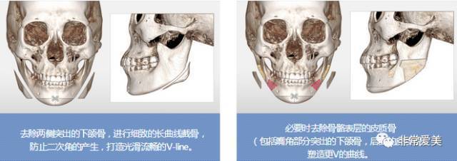 面部骨骼下颌角手术示意图