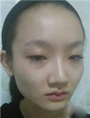 网友赴韩眼鼻+颧骨下颌角整形真实后记分享_术前