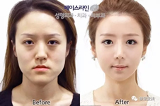 韩国做面部轮廓手术特色有哪些？