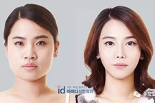 韩国做面部轮廓哪家医院技术好？