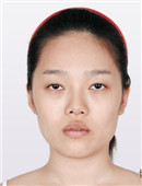 韩国眼鼻修复+面部综合整形记录真实全过程