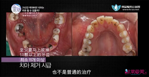 《let美人》韩国NEW FACE口腔医院种植牙患者口腔