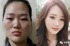 韩国面部轮廓案例对比，术后变化居然这么大！