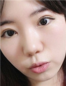 亲身体验：我在韩国割得双眼皮全过程 效果自然无痕_术后