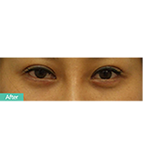 S-ONE整形外科-黑眼圈手术对比图