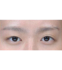 半岛眼整形外科-双眼皮手术对比日记