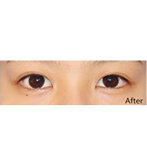 韩国高恩世上整形外科-双眼皮对比图