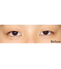 韩国高恩世上整形外科-双眼皮对比图