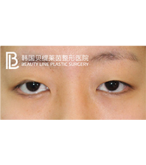 beautyline整形外科-双眼皮对比图