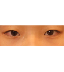 韩国UcanB整形-双眼皮对比图
