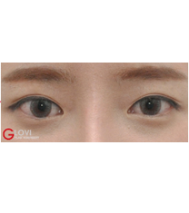 韩国歌柔飞整形-韩国歌柔飞医院眼睑下垂矫正手术案例对比图