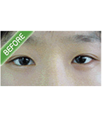 韩国清潭首尔整形外科-双眼皮对比图