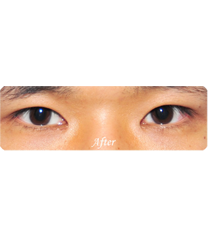 KIES·U整形外科-双眼皮对比图