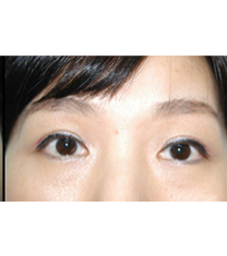 韩国SEIN整形-双眼皮对比图