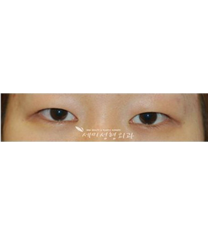 韩国semi整形医院-双眼皮手术对比图