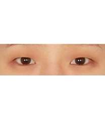 韩国李政自然美-双眼皮手术日记对比图