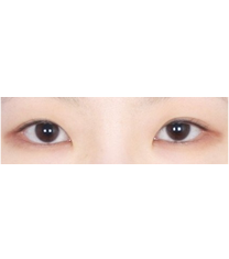 双眼皮手术案例对比图