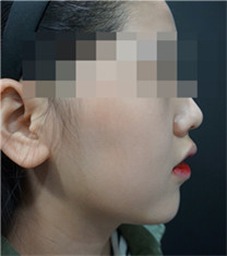 韩国首尔丽格皮肤科-玻尿酸垫下巴对比日记