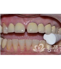 韩国龙plant-牙齿矫正对比日记