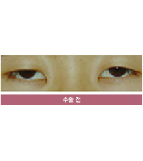 韩国美整形外科眼部手术对比图_术前