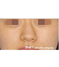 韩国江南UI-隆鼻整形对比日记