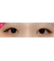 韩国IRIS整形外科-双眼皮手术日记对比图