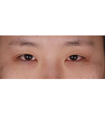 韩国101整形外科医院-开眼角手术日记对比图