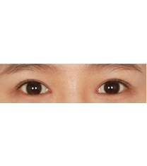 韩国李政自然美-双眼皮手术日记对比图