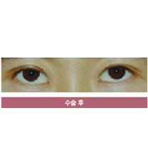 韩国美整形外科眼部手术对比图_术后