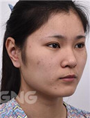 真人案例分享：韩国下颌角+鼻子整形恢复全过程记录_术前