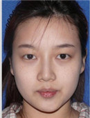 面部自体脂肪填充+玻尿酸隆鼻过程真人案例分享